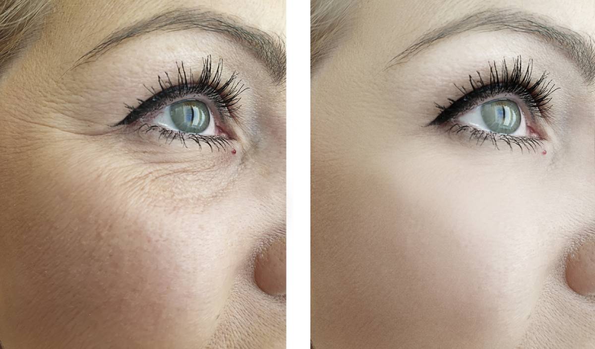 Before and after circle treatment