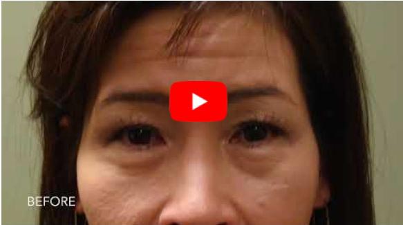 What Can I Do For My Lower Eyelids click to view video