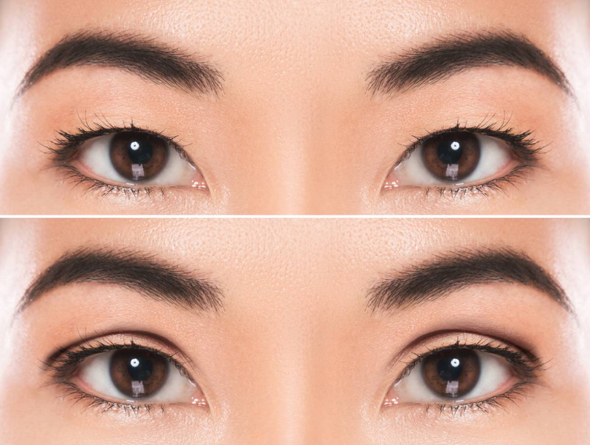 concept image of double eyelids