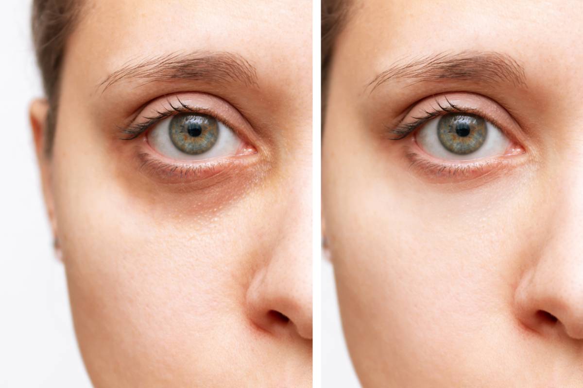 featured image for when to seek treatment for dark circles